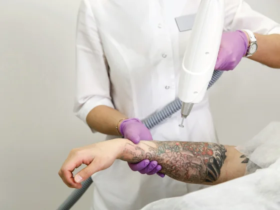 Helios III Laser Tattoo Removal Treatment | Xcite Technologies