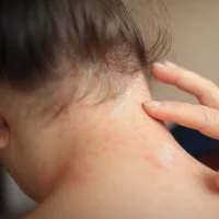 eczema