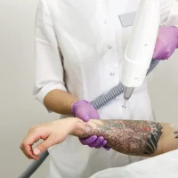 tatoo_removal